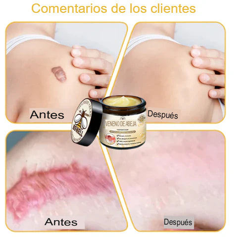 CREMA PARA ARTICULACION Y BERRUGAS VENENO DE ABEJAS 🐝 ¡ENVÍO GRATIS! 💎